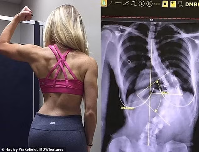 Bị cong cột sống đến hơn 90 độ, cô gái tự điều trị và kết quả không ngờ