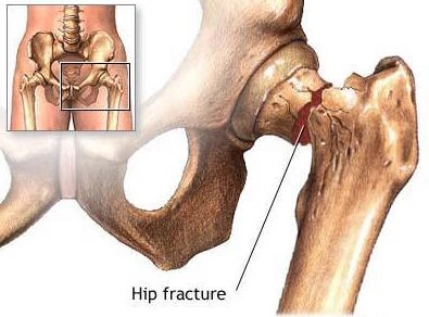 Hôn nhân giúp giảm nguy cơ rạn xương hông khi già