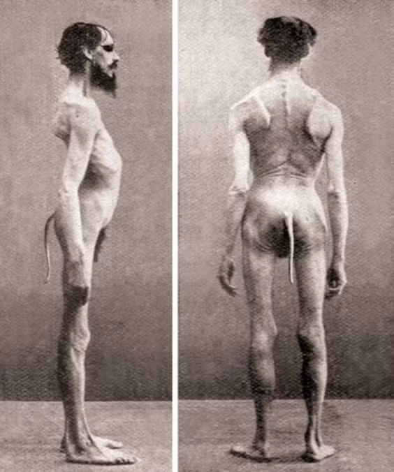 Người đàn ông Ấn Độ này có một chiếc đuôi.... (Ảnh: Internet)