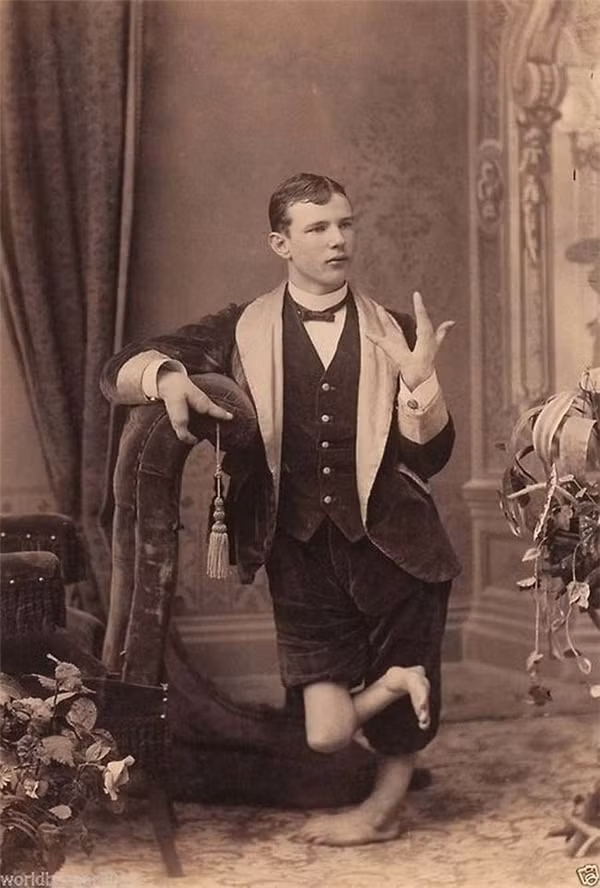 Một anh chàng có tay chân dị dạng. (Ảnh: Internet)