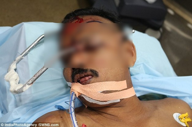 Bị thanh thép đâm xuyên hộp sọ, người đàn ông sống sót thần kỳ ảnh 1  Thanh thép đâm xuyên đầu Ullas
