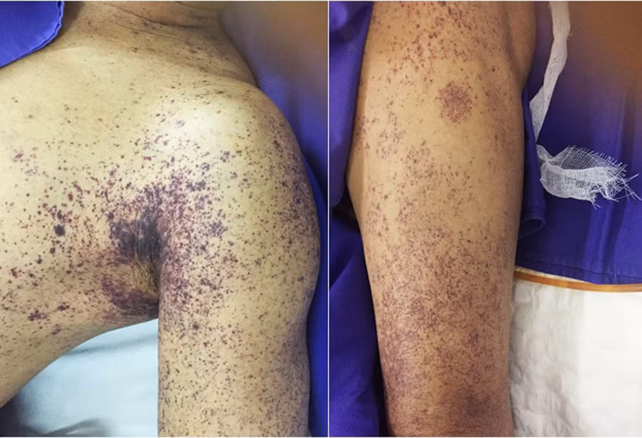 Bệnh liên cầu lợn có thể dẫn tới tử vong