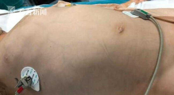 Bé trai 4 tuổi có bụng nhô cao như phụ nữ mang thai và nguyên nhân khiến mọi người giật mình - Ảnh 2. Bé trai 4 tuổi có bụng nhô cao như phụ nữ mang thai và nguyên nhân khiến mọi người giật mình - Ảnh 2.