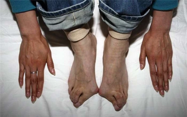 Sốc với đôi bàn chân biến dạng của cựu vận động viên điền kinh