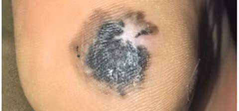 Thấy đốm đen ở gót chân, người đàn ông không ngờ mắc căn bệnh nguy hiểm này