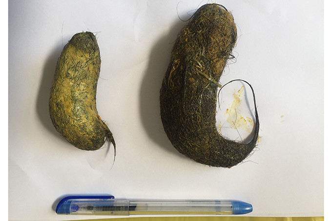 Hai khối u tóc của bé gái được lấy ra Hai khối u tóc của bé gái được lấy ra