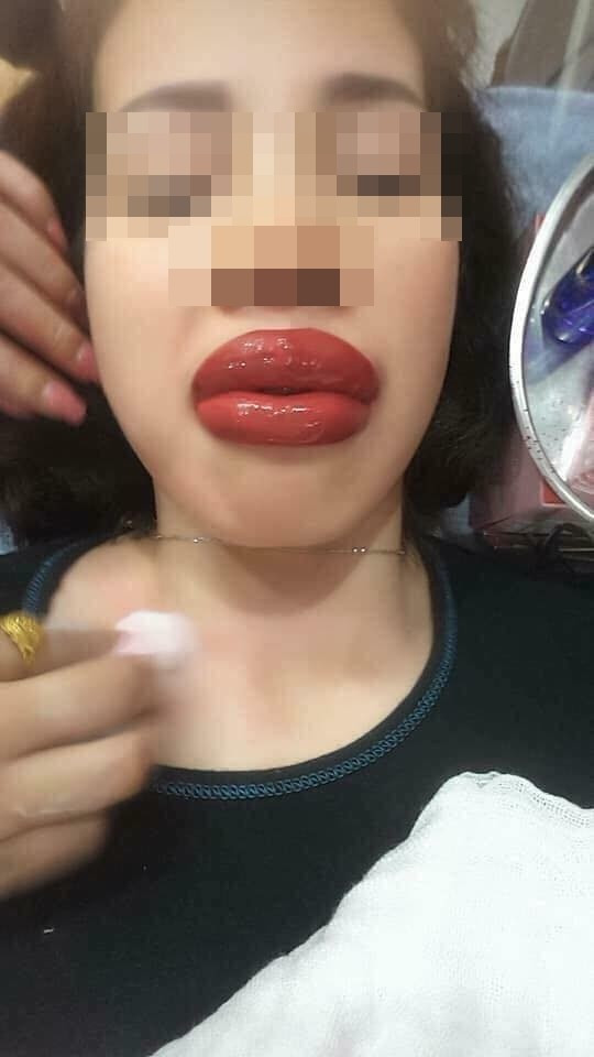 Đôi môi sưng tều khiến nhiều người cảm thông nhưng vẫn không thể nhịn cười.