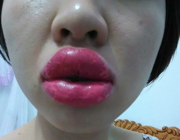 Liệu đôi môi này có trở lại được như bình thường.