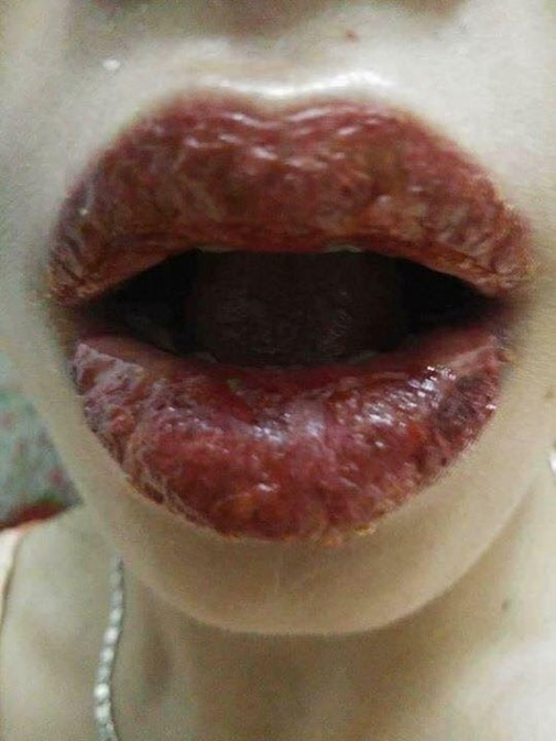 Đôi môi này cũng bị biến chứng do xăm môi.
