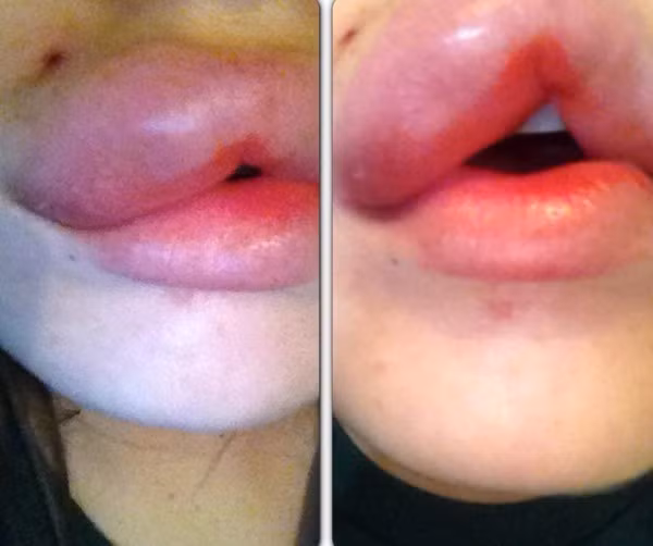 Đi xăm môi làm đẹp, cô gái không dám ra đường vì môi sưng tều như 2 cây xúc xích