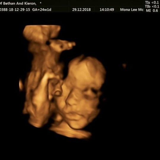 Đưa thai nhi ra khỏi bụng mẹ chữa bệnh rồi đưa vào lại - Ảnh 1.