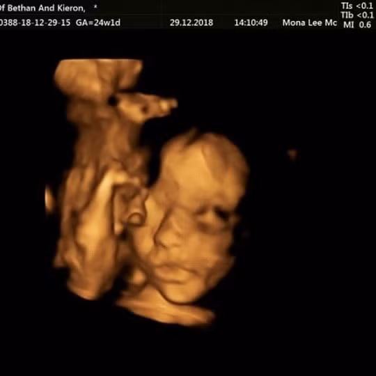 Đưa thai nhi ra khỏi bụng mẹ chữa bệnh rồi đưa vào lại - Ảnh 1.