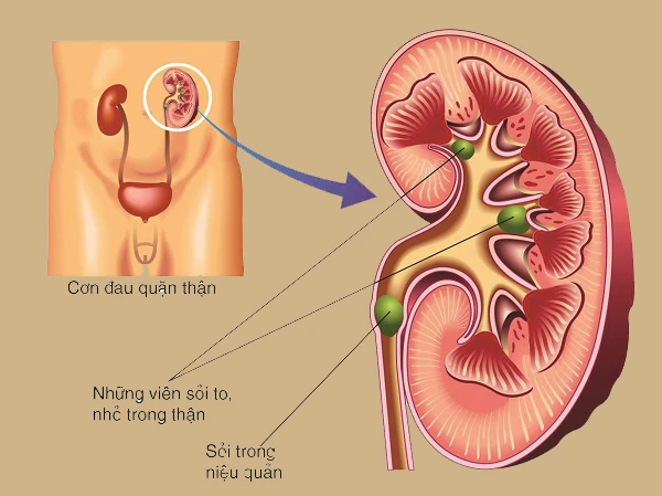 Bác sĩ chỉ điểm 5 nguyên nhân gây bệnh sỏi thận hàng đầu hiện nay