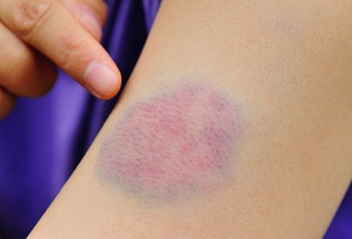 Nguy hiem cuc mau dong, 5 dau hieu khong the bo qua