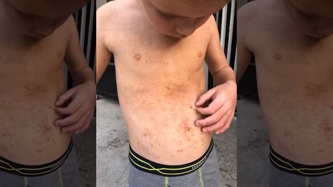 Sau khi hai chanh ban tay be trai bi phong sung phong