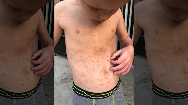 Sau khi hái chanh bàn tay bé trai bị phỏng sưng phồng Sau khi hai chanh ban tay be trai bi phong sung phong