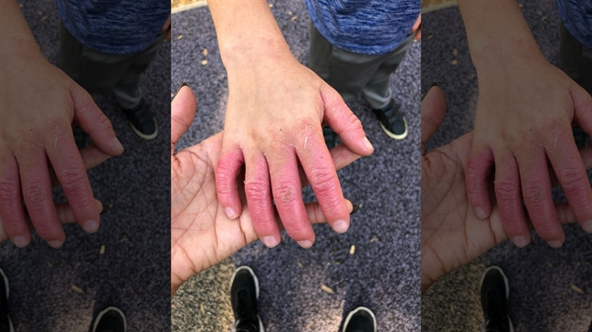 Sau khi hái chanh bàn tay bé trai bị phỏng sưng phồng Sau khi hai chanh ban tay be trai bi phong sung phong