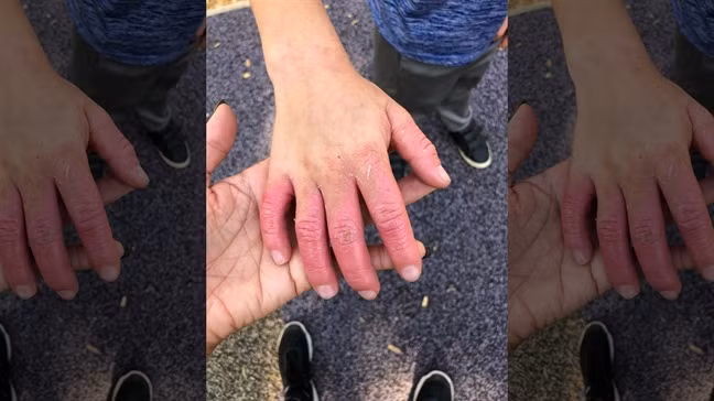 Sau khi hái chanh bàn tay bé trai bị phỏng sưng phồng