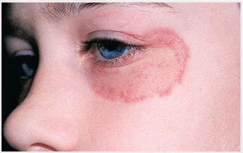 Ap dung meo dan gian don gian sau de chua benh HAC LAO