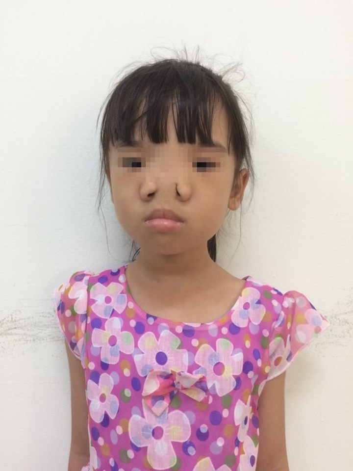 Cháu Lê L.P. trước khi phẫu thuật.
