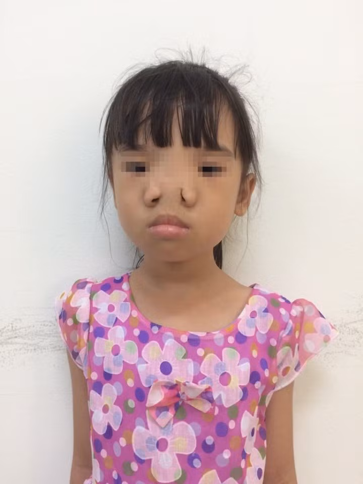 Cháu Lê L.P. trước khi phẫu thuật.