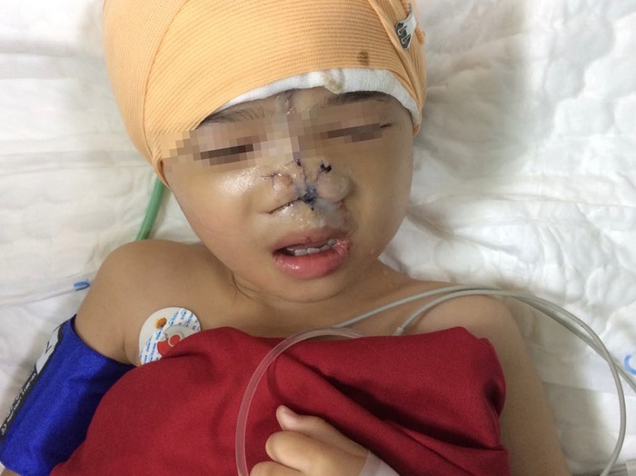 Ca phẫu thuật thành công giúp cháu bé trở lại với khuôn mặt bình thường.