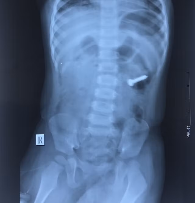 Dị vật quan sát qua film X-Quang.