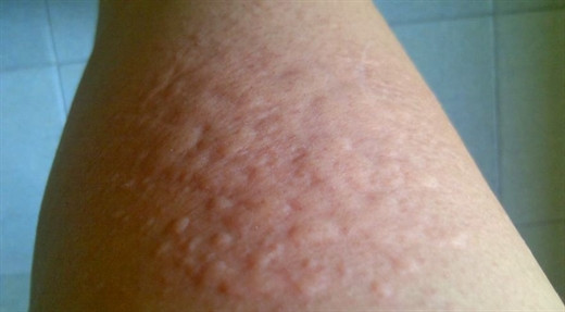 Mach ban cach dung la tia to chua me day