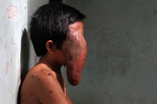 Indonesia: “Người mặt voi” khiến ai nhìn cũng khiếp sợ ảnh 4