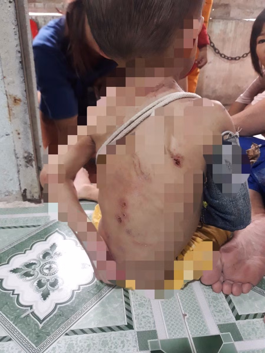 Nhiều vết thương trên người bé trai.