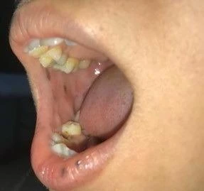 Các nốt sắc tố sậm màu rải rác trên môi, niêm mạc má của bệnh nhân