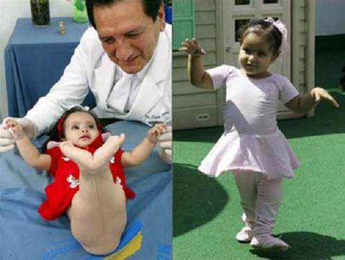 "Nàng tiên cá nhỏ" Milagros Cerron trước và sau phẫu thuật tách chân.