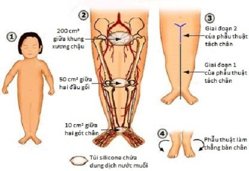 Hình minh họa một em bé mắc Hội chứng người cá (trái), quá trình giải phẫu tách hai chân (giữa và phải).