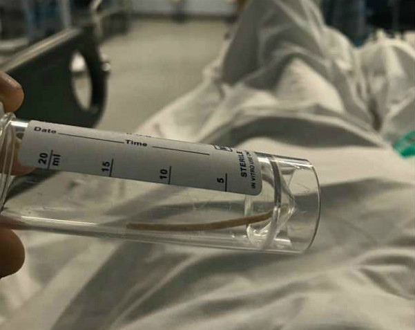 Chiếc que tránh thai đi lạc trong cơ thể Louise. Chiếc que tránh thai đi lạc trong cơ thể Louise. Ảnh: D.L