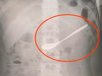 Cô gái trẻ nuốt thìa khuấy cà phê vào dạ dày