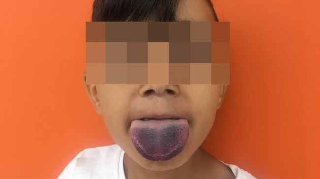 Cấp cứu cậu bé 7 tuổi lưỡi mắc kẹt trong cổ chai ảnh 1 Cau be 7 tuoi phai nhap vien vi luoi mac ket trong co chai hinh anh 2