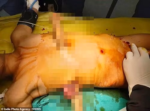 cau be song sot ky dieu sau khi bi canh cay dam xuyen nguoi van co dat em ve nha - 2