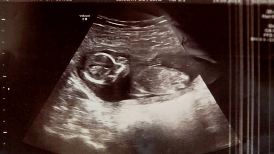 Thai nhi sống sót kỳ diệu sau khi bà mẹ phải uống thuốc phá thai theo chỉ định của bác sĩ - Hình 2