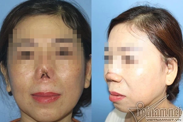Mũi quý bà Sài Gòn cụt lủn sau nâng mũi tại thẩm mỹ viện