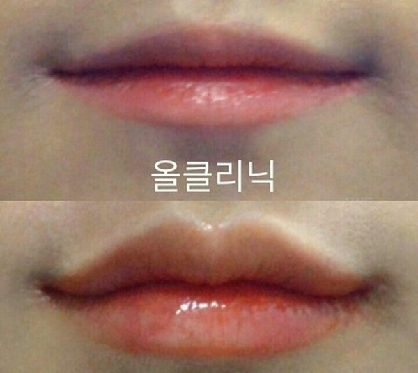 Thiếu nữ Hàn đổ xô tạo hình môi chữ M giống "chị đẹp" Son Ye Jin