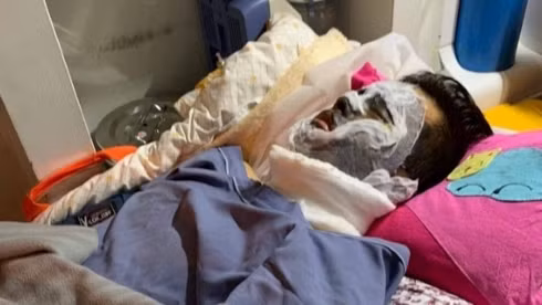 Nạn nhân bị bỏng 80% cơ thể - Ảnh: Internet 