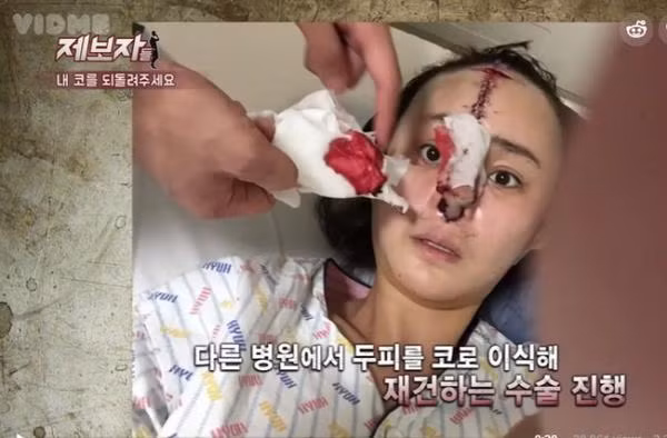 Cô gái sở hữu chiếc mũi kinh dị ảnh 3