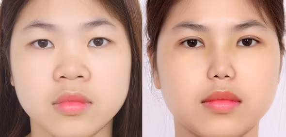 Cắt mí mắt những lưu ý cần biết trước và sau khi phẫu thuật