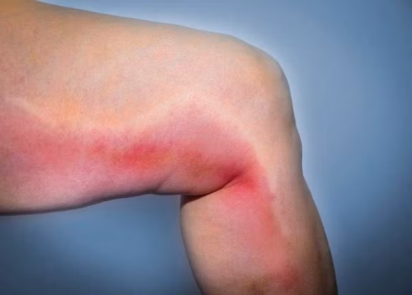 Biến chứng nguy hiểm nhất của huyết khối tĩnh mạch sâu là thuyên tắc phổi, huyết khối tĩnh mạch.