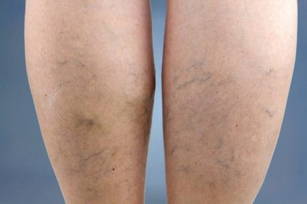 Nếu có 4 dấu hiệu này ở chân, đi khám ngay vì căn bệnh gây chết nhanh hơn ung thư ảnh 2 neu co 4 dau hieu nay o chan, di kham ngay vi can benh gay chet nhanh hon ung thu - 4
