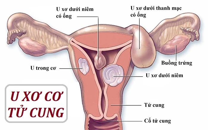 U xơ tử cung là bệnh phụ khoa phổ biến.