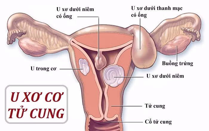 U xơ tử cung là bệnh phụ khoa phổ biến.