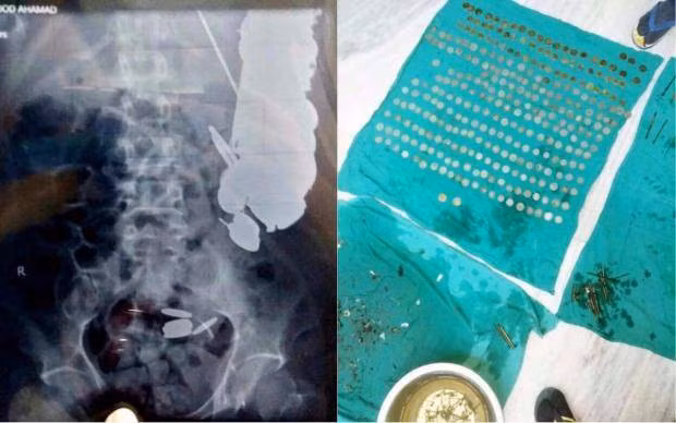 Bác sĩ gắp ra 263 đồng xu từ dạ dày bệnh nhân