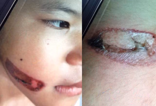 Vết bỏng trên mặt và tay bé T. Ảnh: Giáo viên cung cấp.