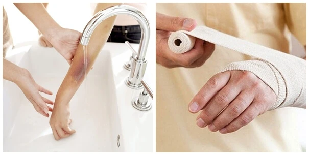 Những cách trị vết bỏng không lo để lại sẹo